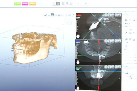 歯科用CTスキャン画像